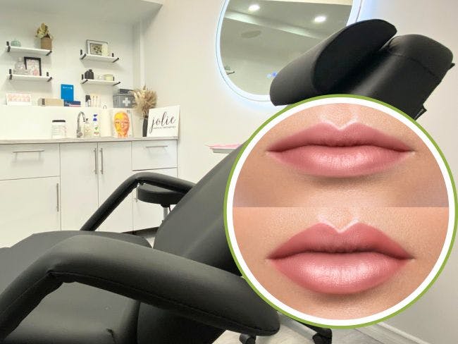 Lips without lip enhancement filer versus lips with lip enhancement filler