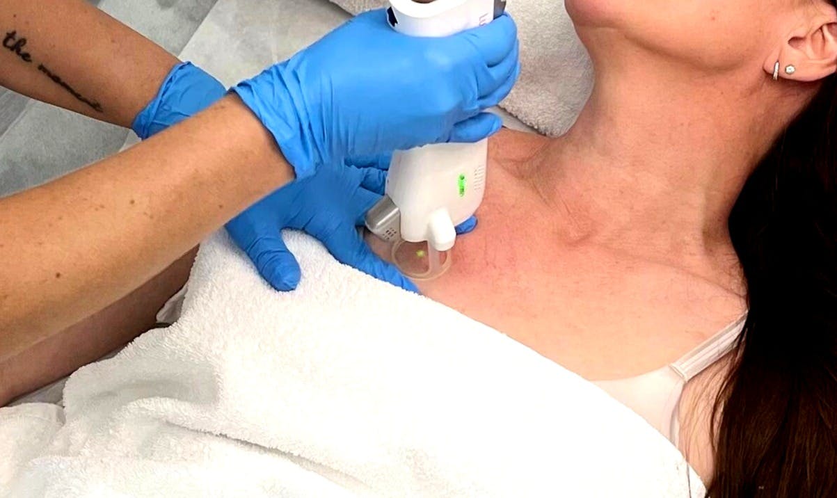 Laser technician performing Vascular lesion removal on a woman upper chest area